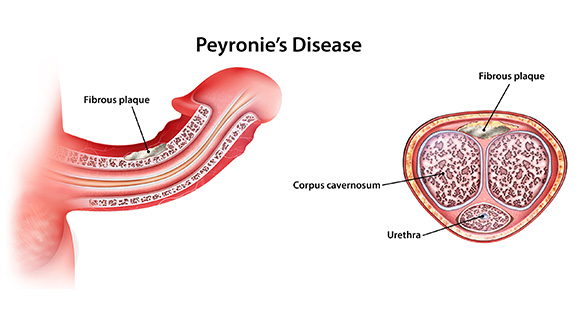 a diagram showing what Peyronie's Disease is, highlighing the plaque buildup that causes it