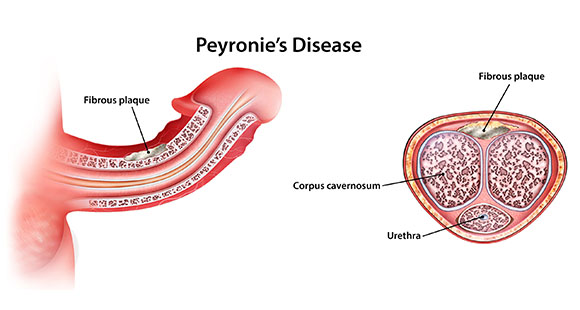 a diagram detailing what Peyronie's Disease is