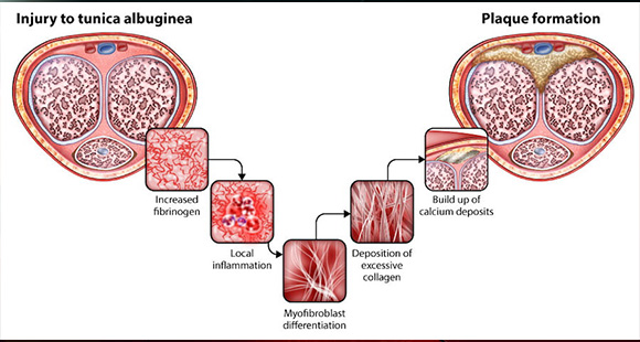 an illustration showing the process of penile plague forming in Peyronie's Disease