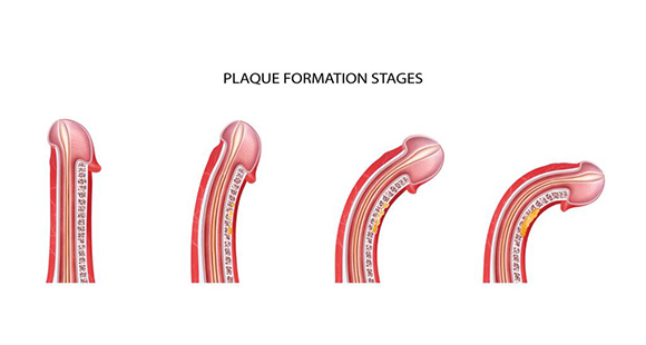 an illustration showing off the stages of plaque formation in Peyronie's Disease