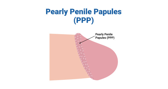 an illustration showing what pearly penile papules are
