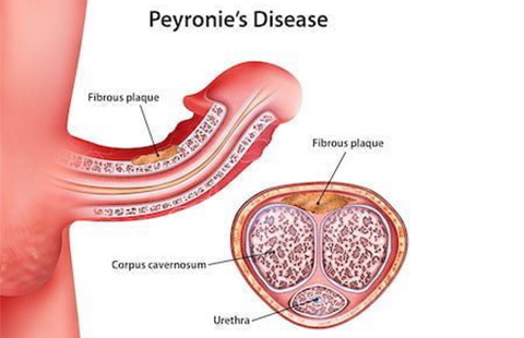 Peyronie's Disease Treatments in London