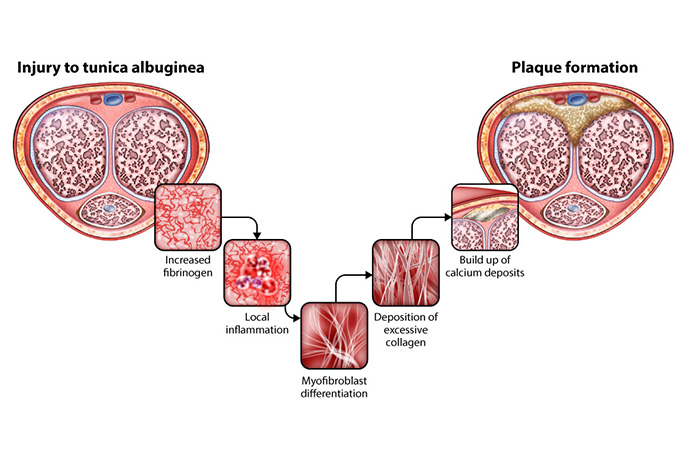 an illustration of the stages of plaque formation that cause Peyronie's Disease