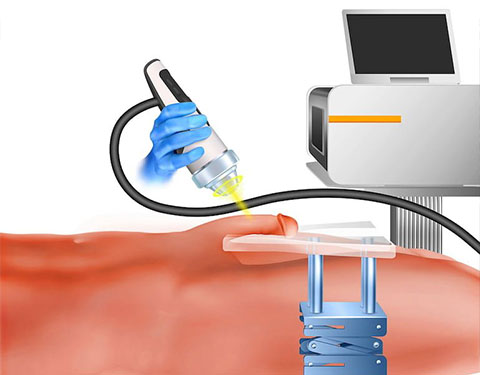 an illustration showing how shockwave therapy works for a treatment for Peyronie's Disease