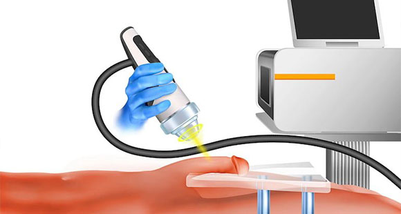 an illustration for shockwave therapy to treat Peyronies' Disease