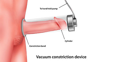a diagram showing how a penile pump works as a treatment for Peyronie's Disease