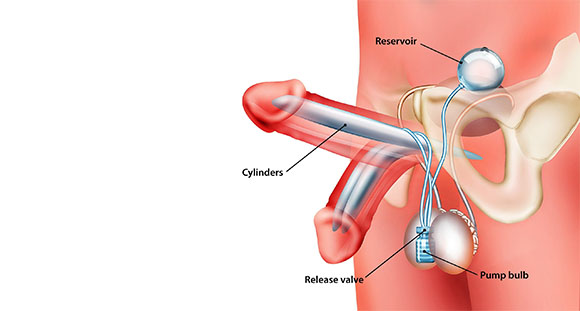 a diagram of a penile implant