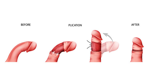 a diagram showing the process of penile plication as treatment for Peyronie's Disease