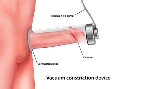 an illustration of a person undergoing a vacuum pump therapy for Peyronie's Disease