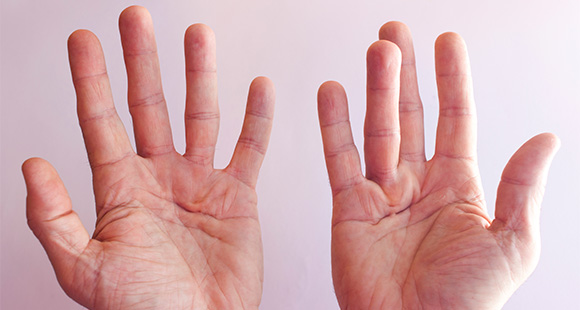 a person holding up their hands, with one hand experiencing Dupuytren's Contracture
