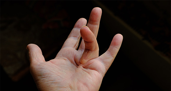 a person with Dupuytren's Disease in their hand against a black background