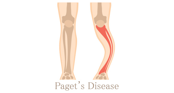 an illustration displaying what Paget's Disease is