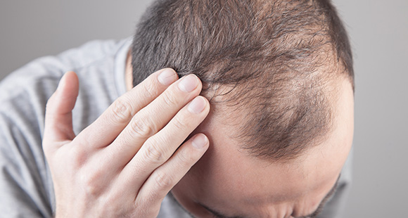 hair thinning highlighted on a man's scalp