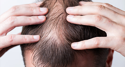 a close-up of a man's thinning hair