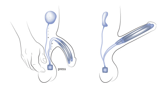 an illustration showing how penile implants work