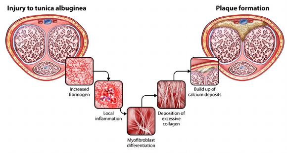 a cross section showing the stages of Peyronie's Disease